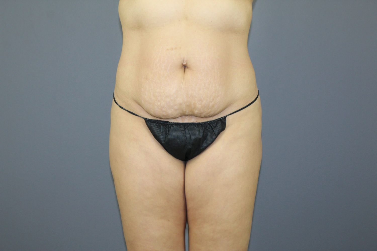 Tummy Tuck Before & After