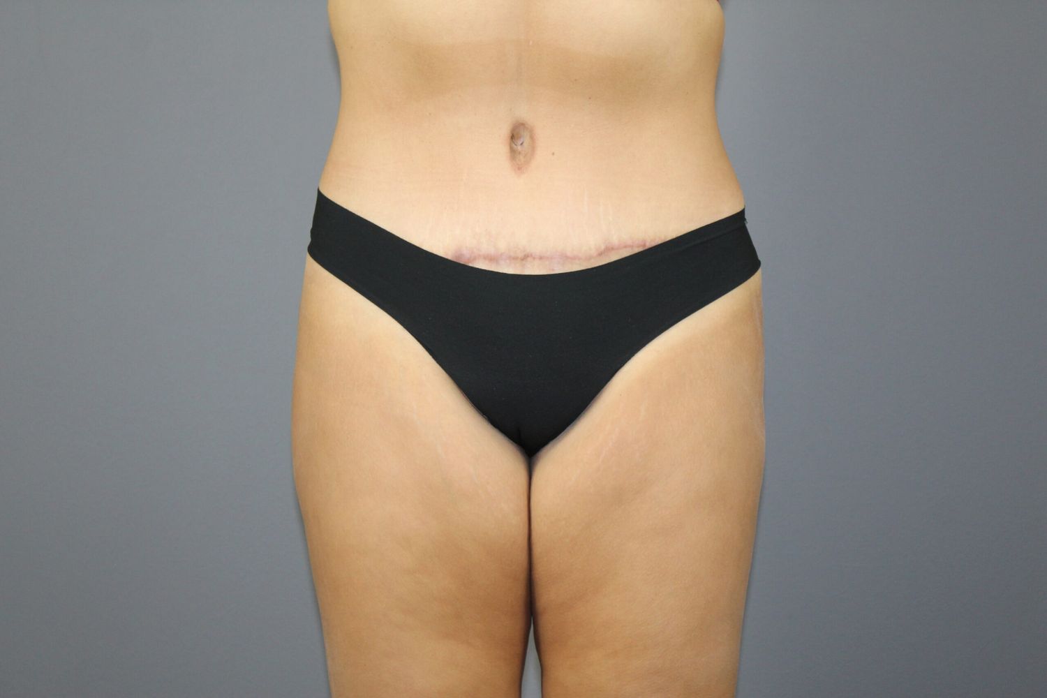 Tummy Tuck Before & After