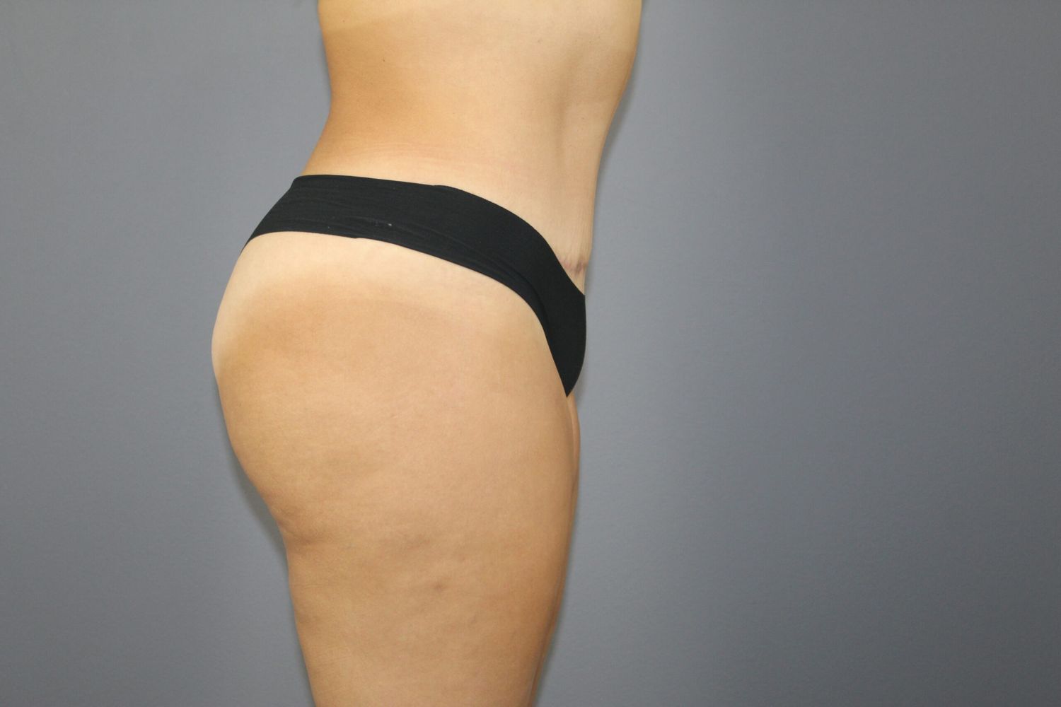 Tummy Tuck Before & After