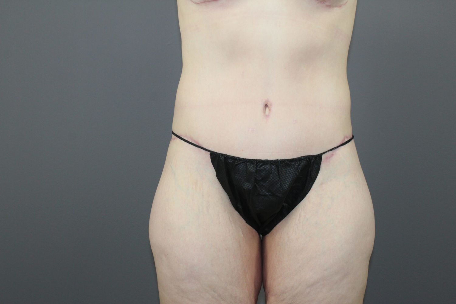 Tummy Tuck Before & After