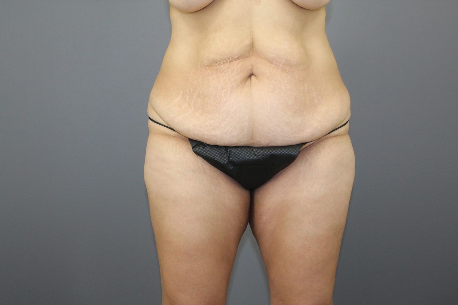 Tummy Tuck Before & After