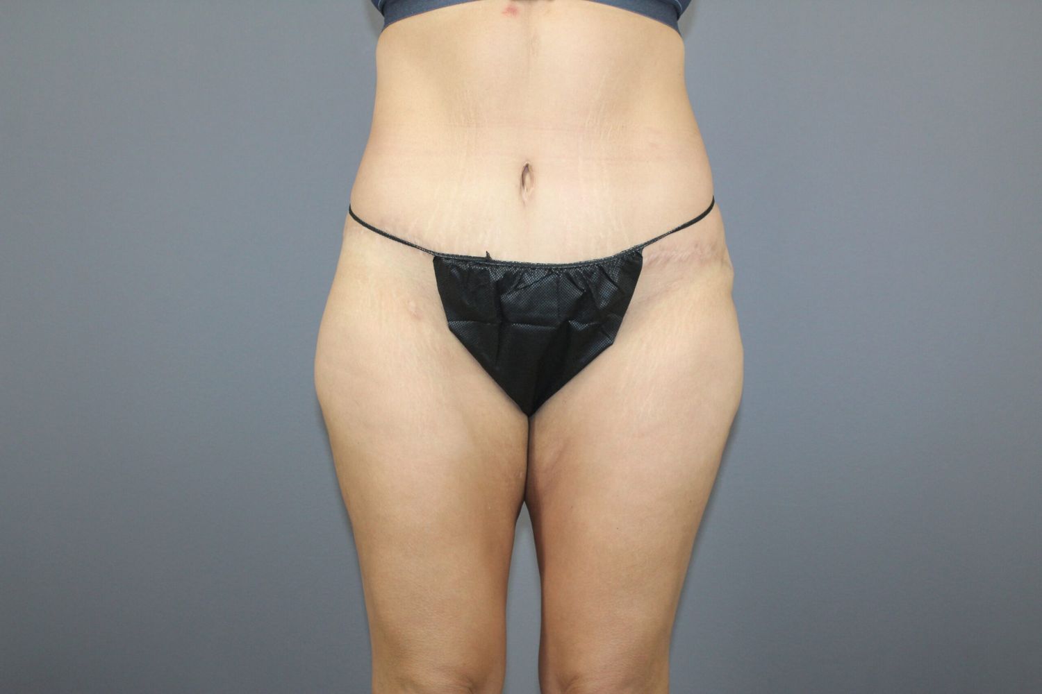 Tummy Tuck Before & After