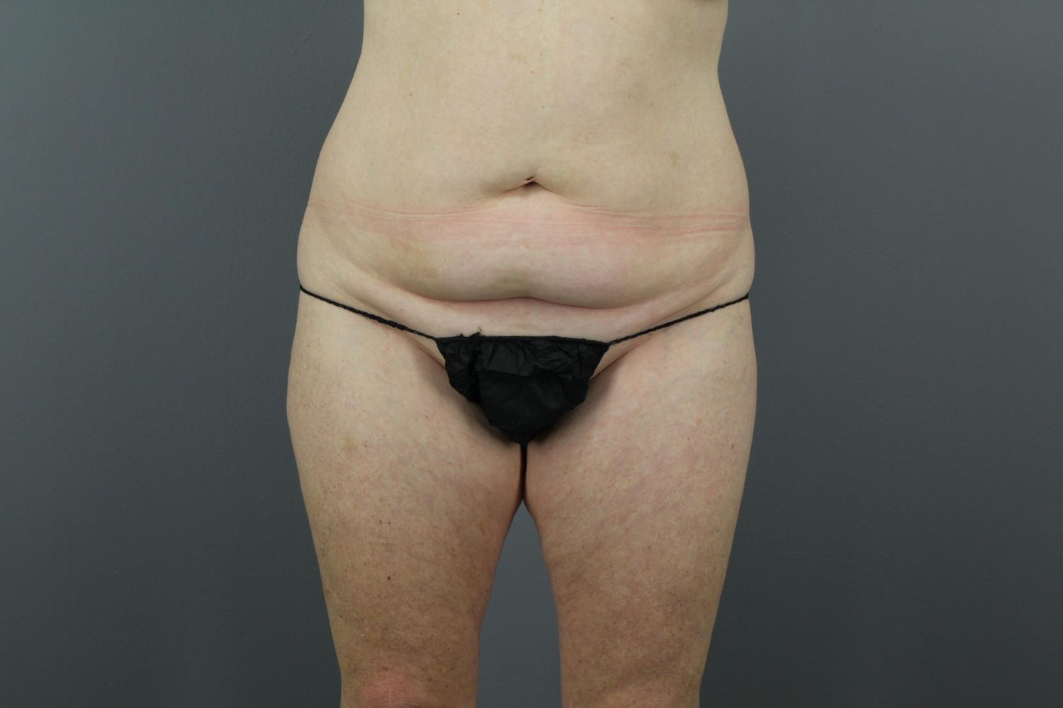 Tummy Tuck Before & After