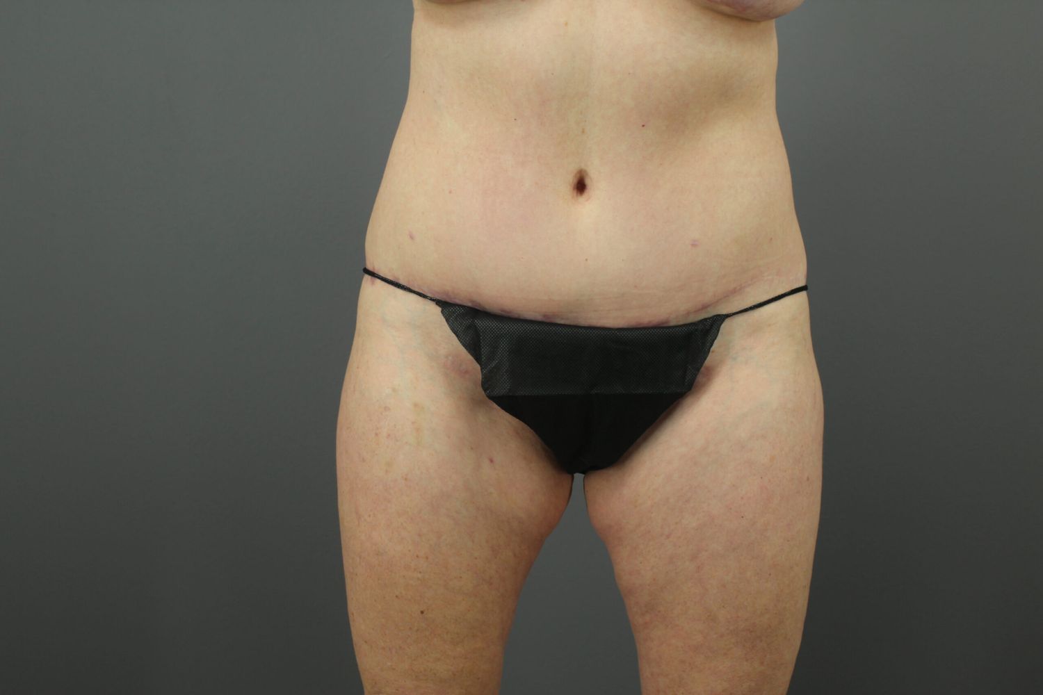 Tummy Tuck Before & After