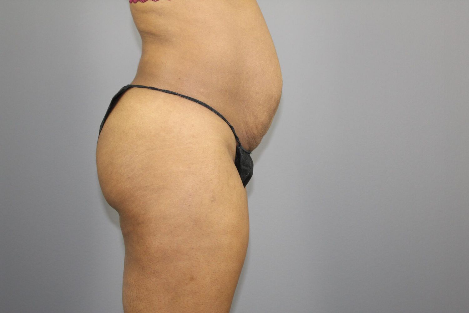Tummy Tuck Before & After