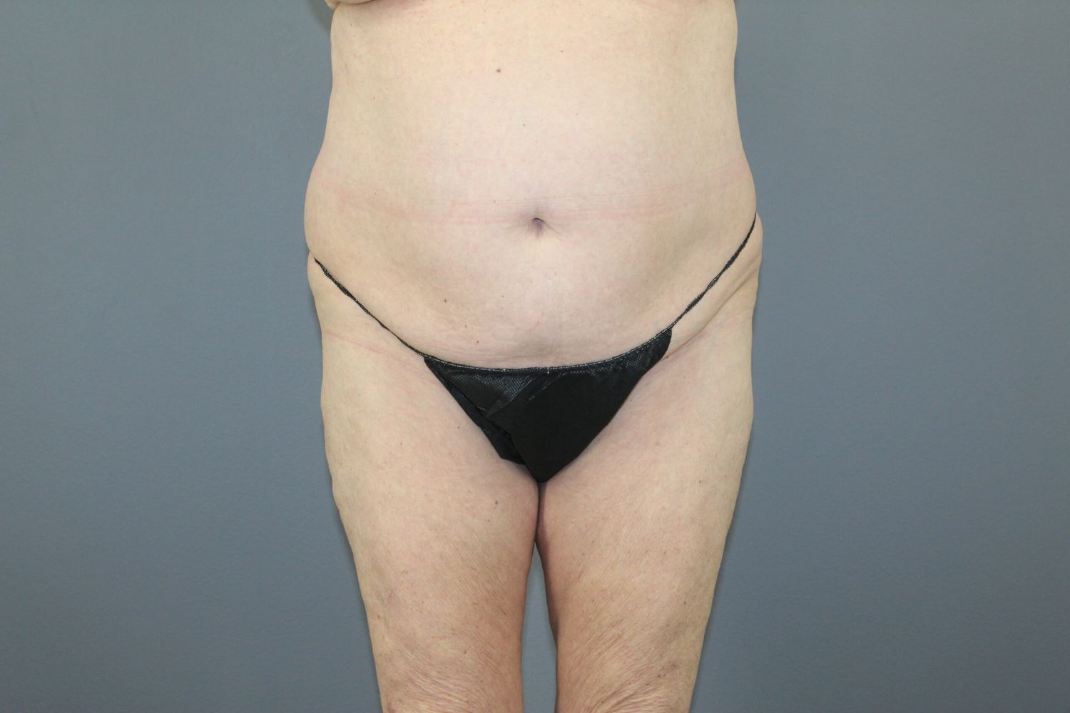 Tummy Tuck Before & After