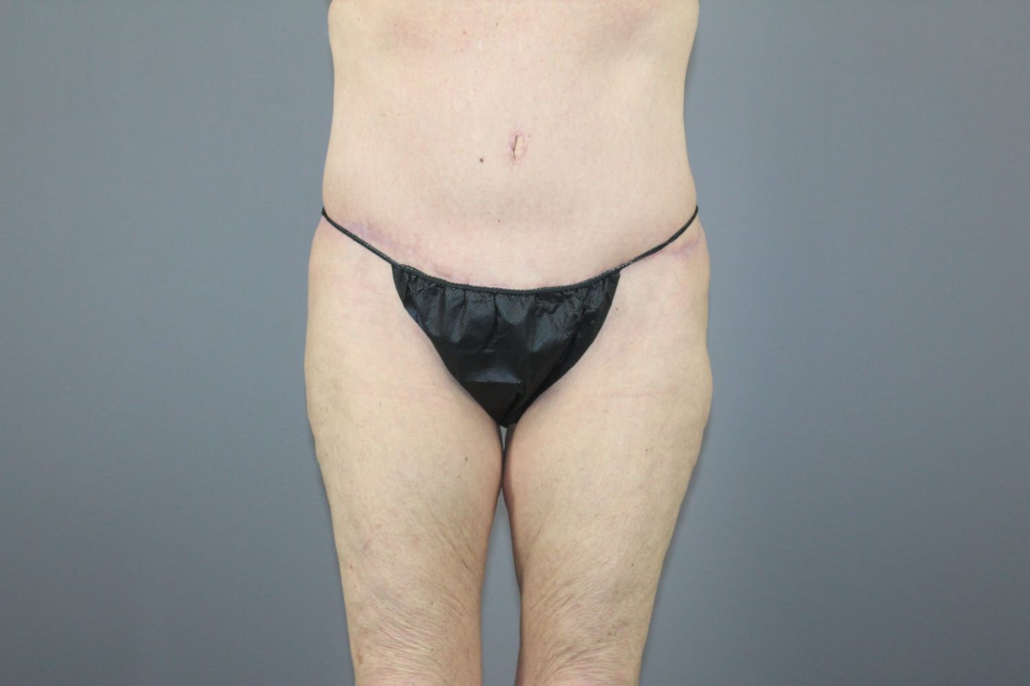 Tummy Tuck Before & After