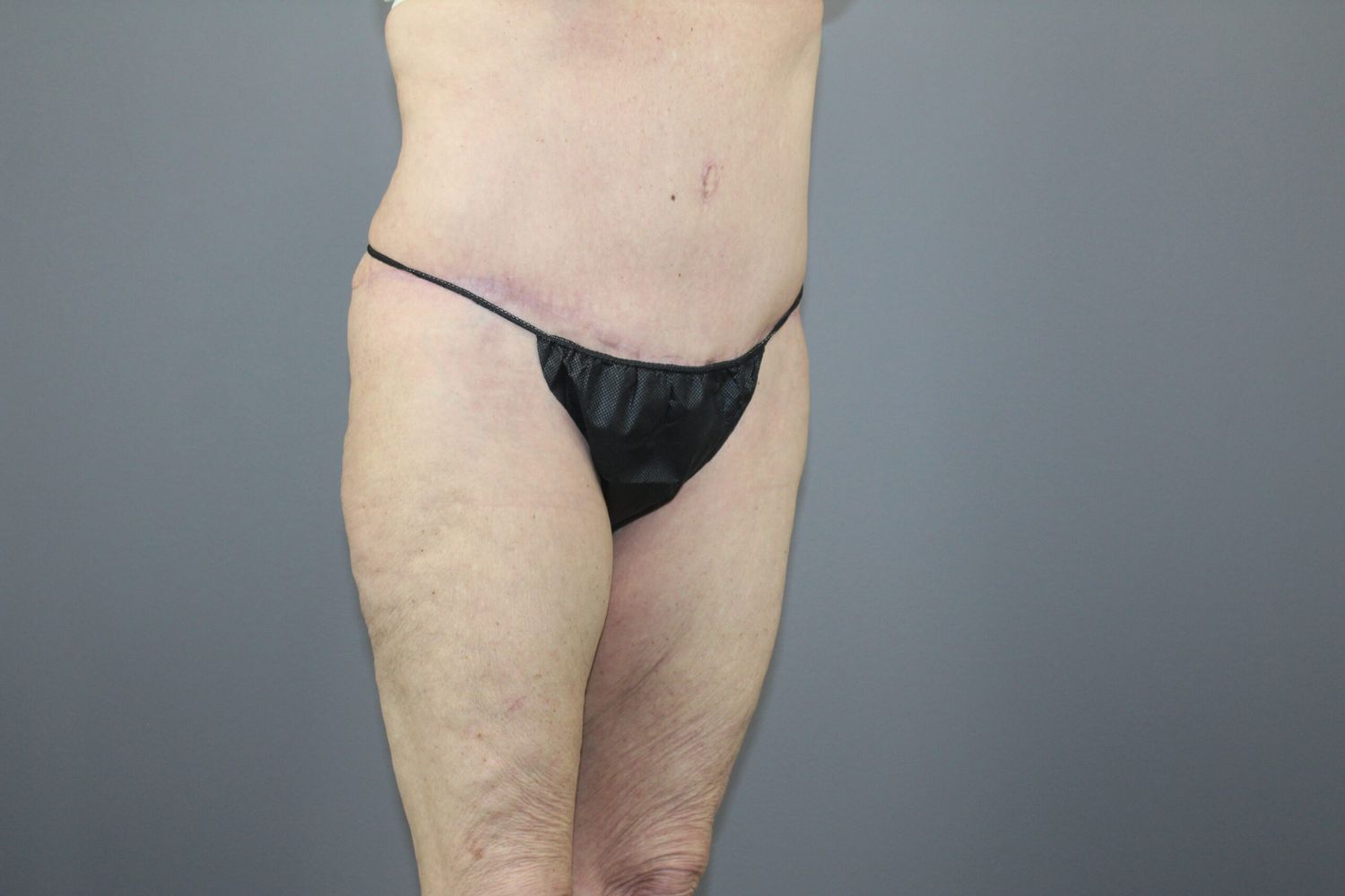 Tummy Tuck Before & After