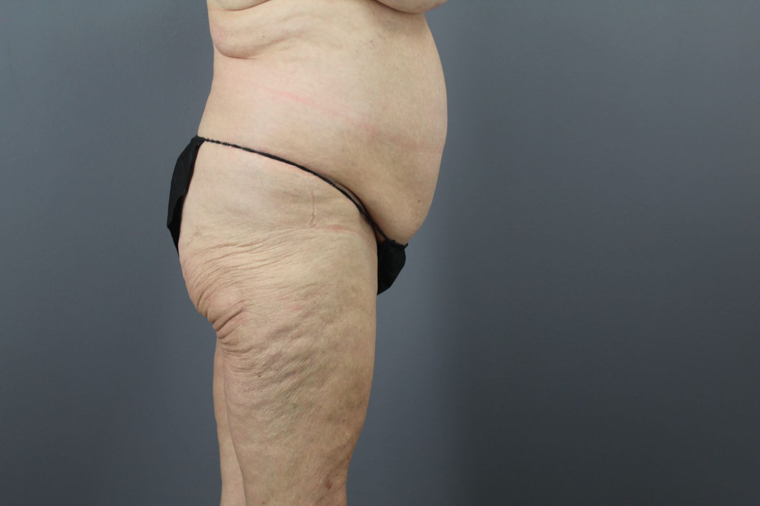 Tummy Tuck Before & After