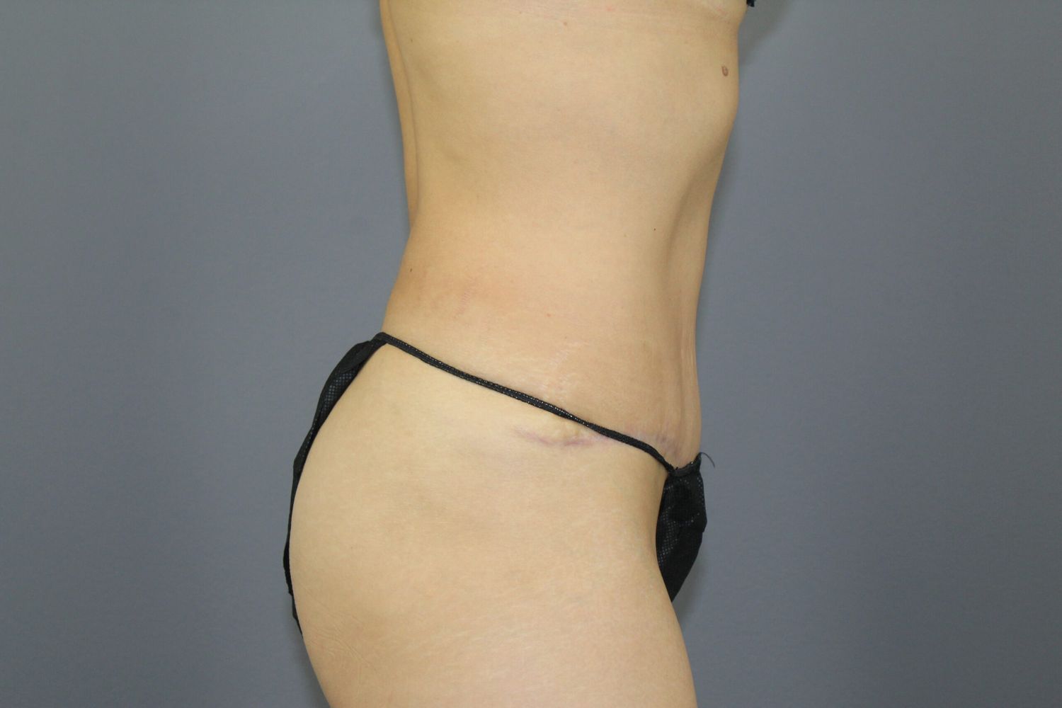 Tummy Tuck Before & After