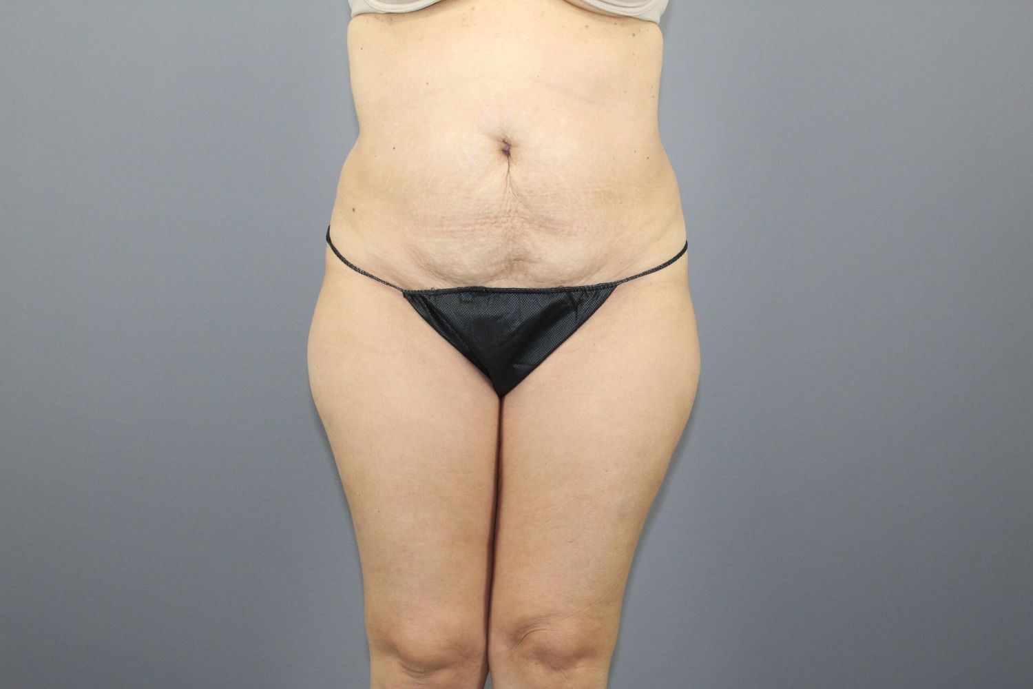 Tummy Tuck Before & After