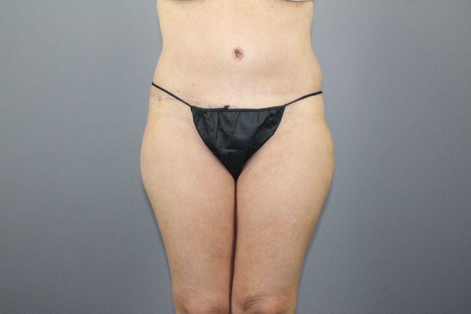 Tummy Tuck Before & After