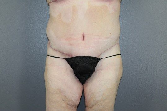 Tummy Tuck Before & After
