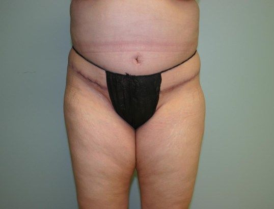 Tummy Tuck Before & After