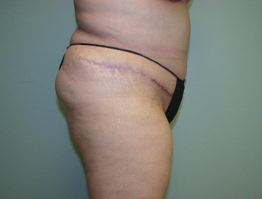 Tummy Tuck Before & After