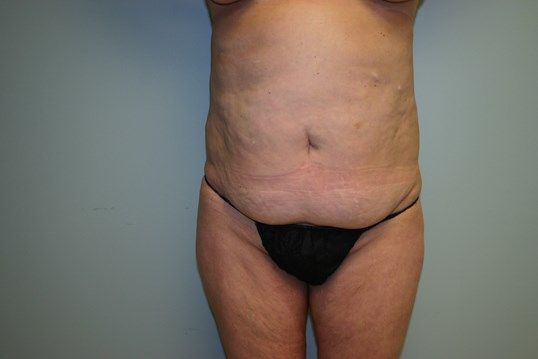 Tummy Tuck Before & After