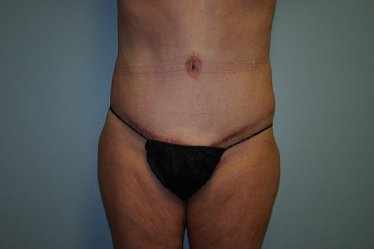 Tummy Tuck Before & After