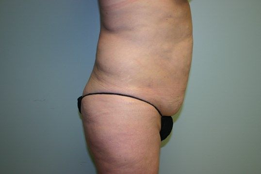 Tummy Tuck Before & After