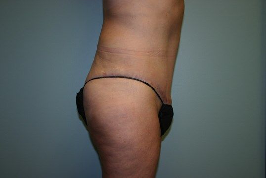 Tummy Tuck Before & After