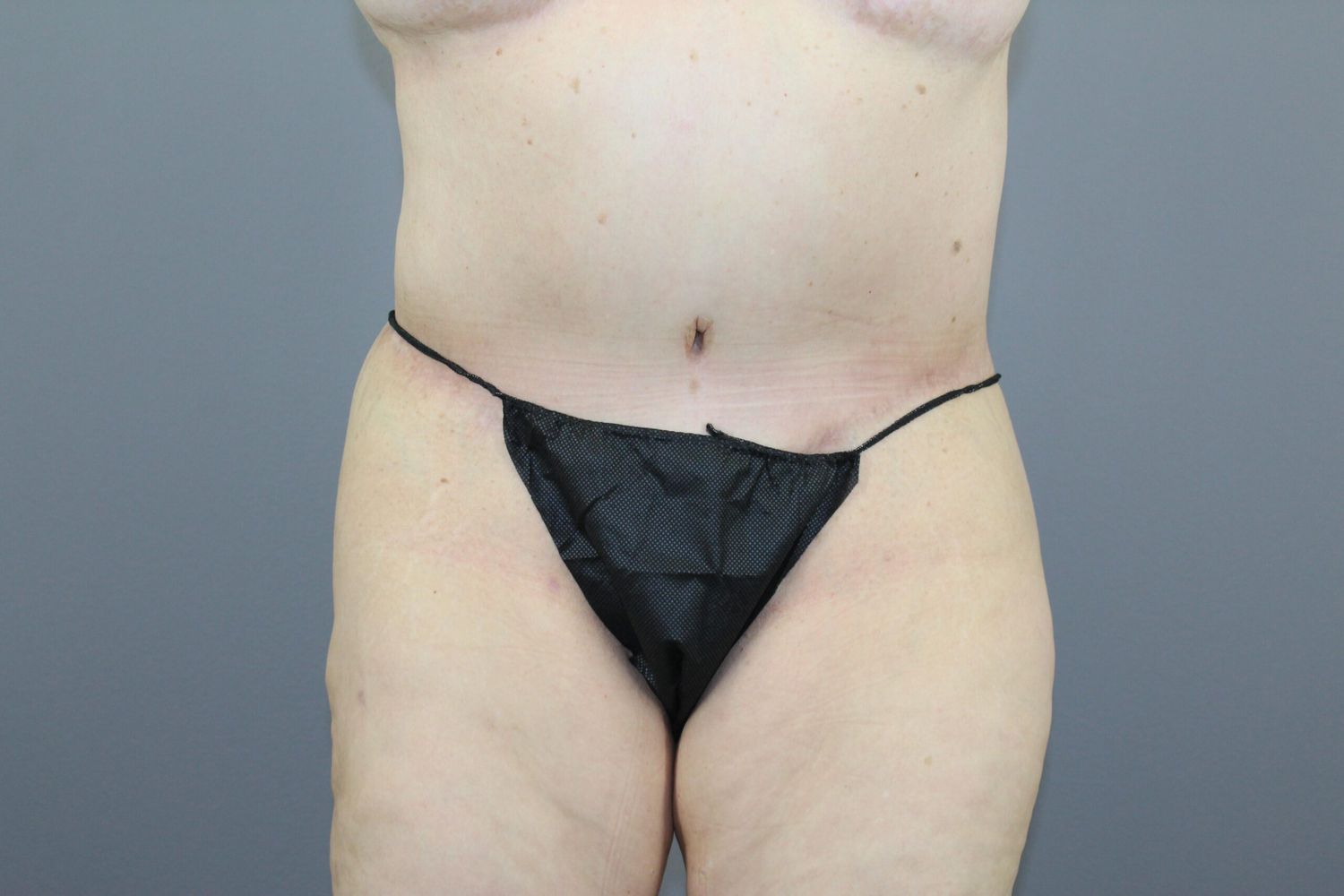 Tummy Tuck Before & After