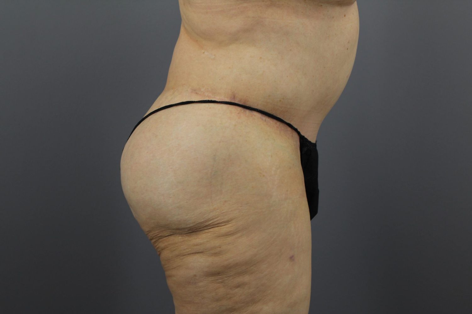 Tummy Tuck Before & After