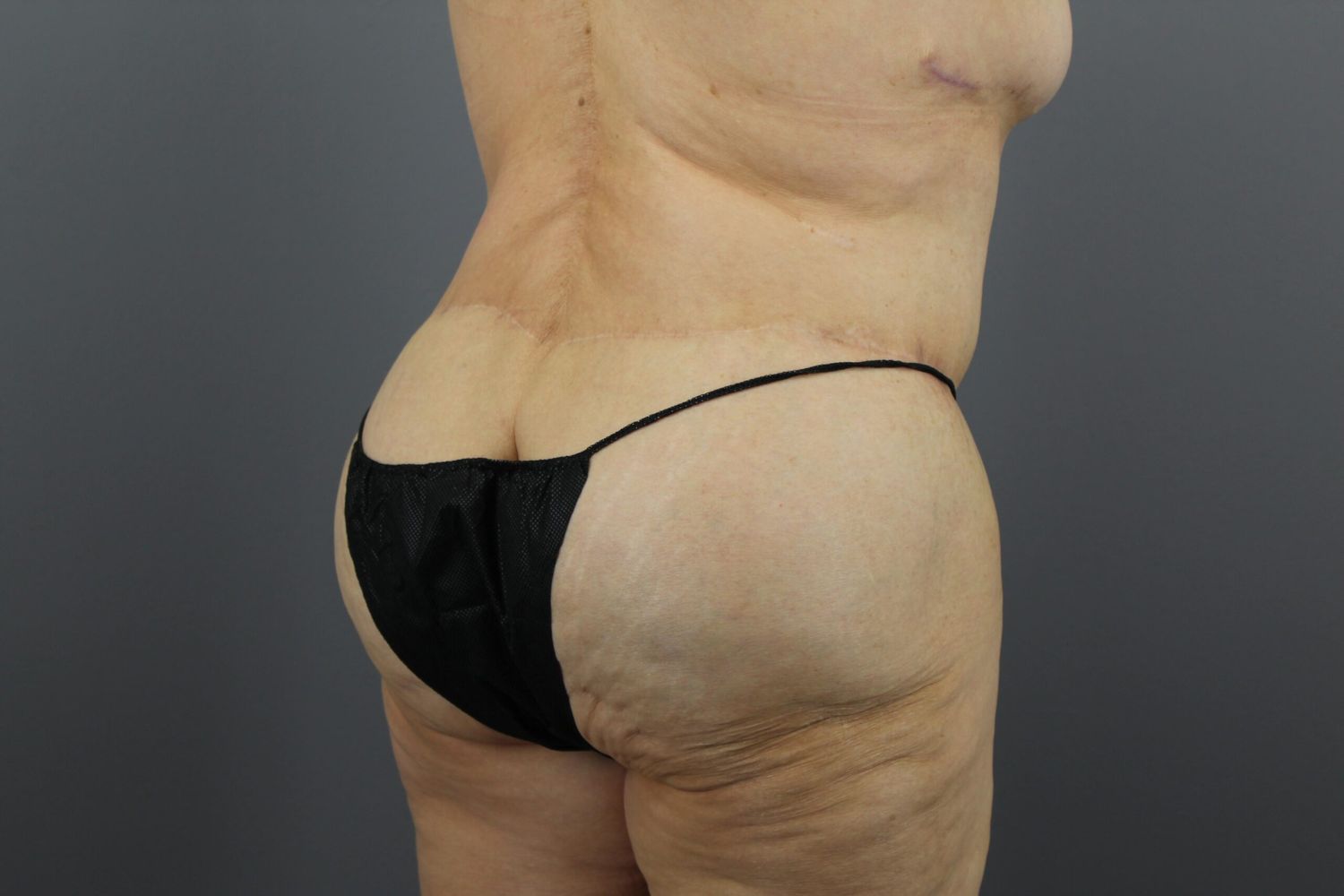 Tummy Tuck Before & After
