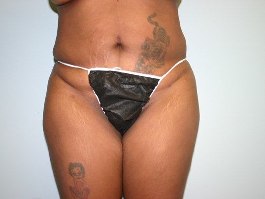 Tummy Tuck Before & After