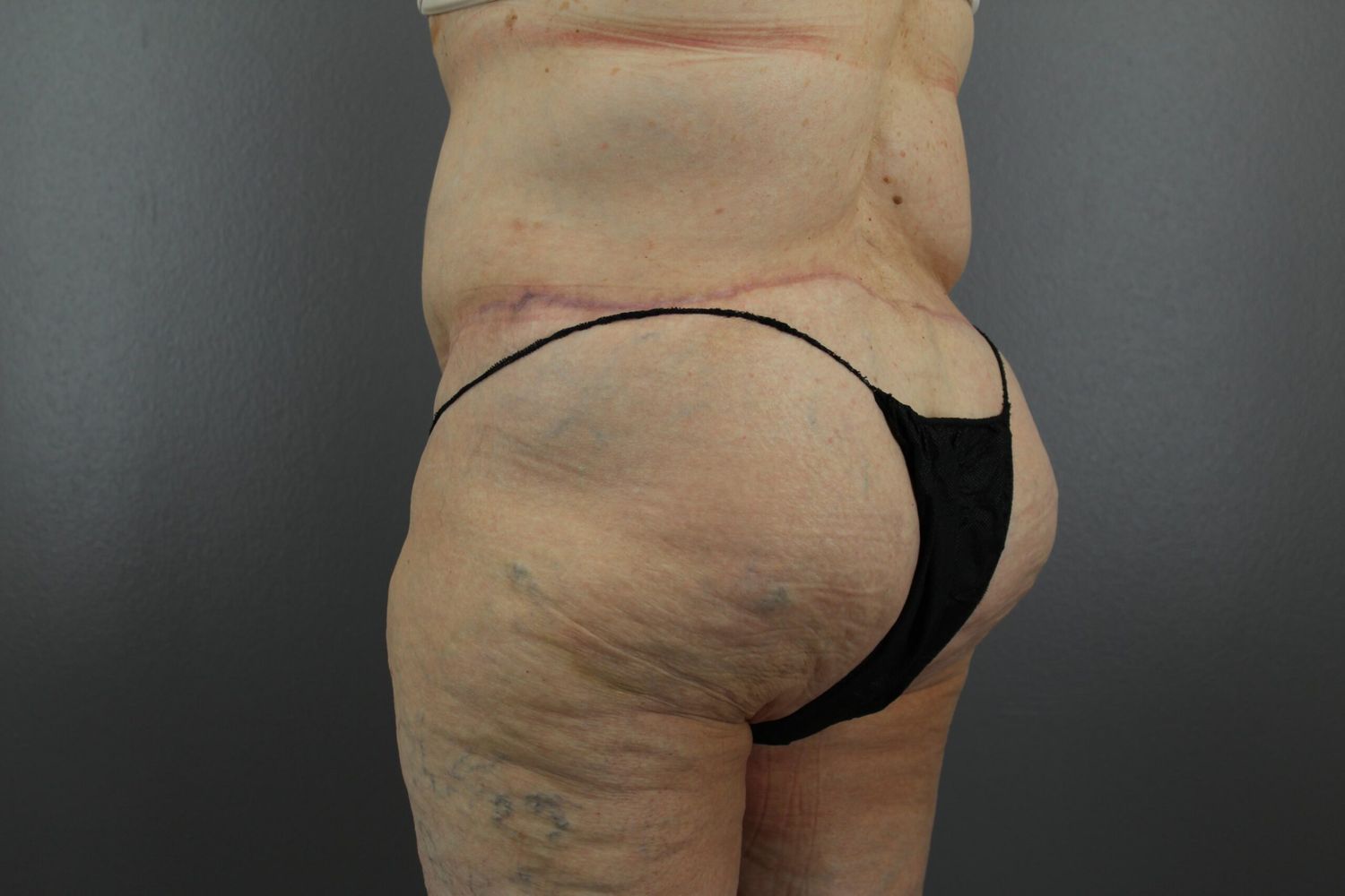 Tummy Tuck Before & After