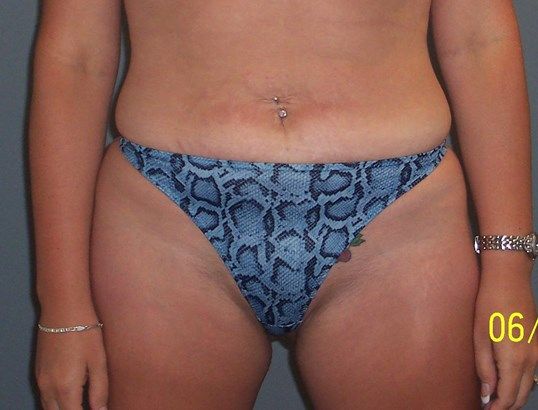 Tummy Tuck Before & After
