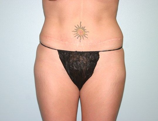 Tummy Tuck Before & After