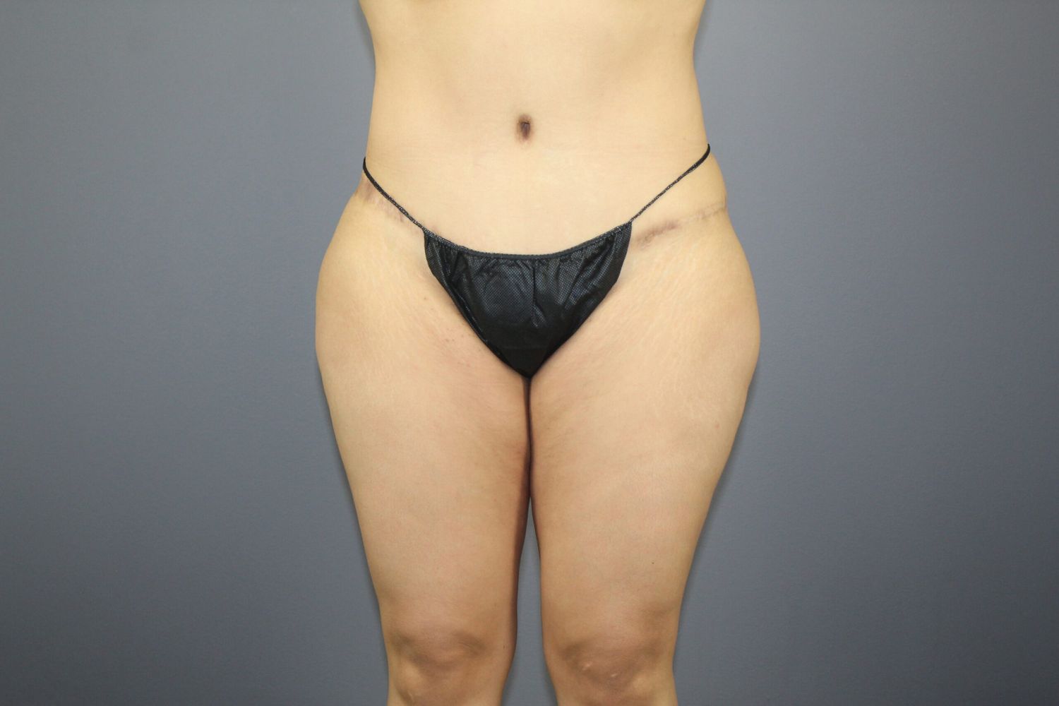 Tummy Tuck Before & After