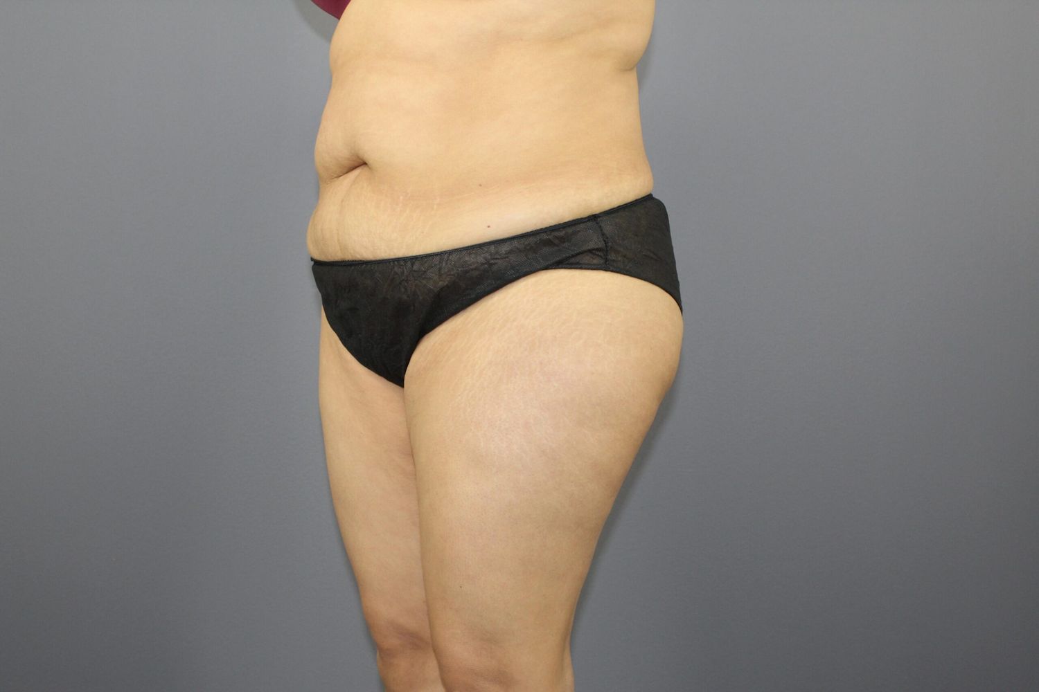 Tummy Tuck Before & After