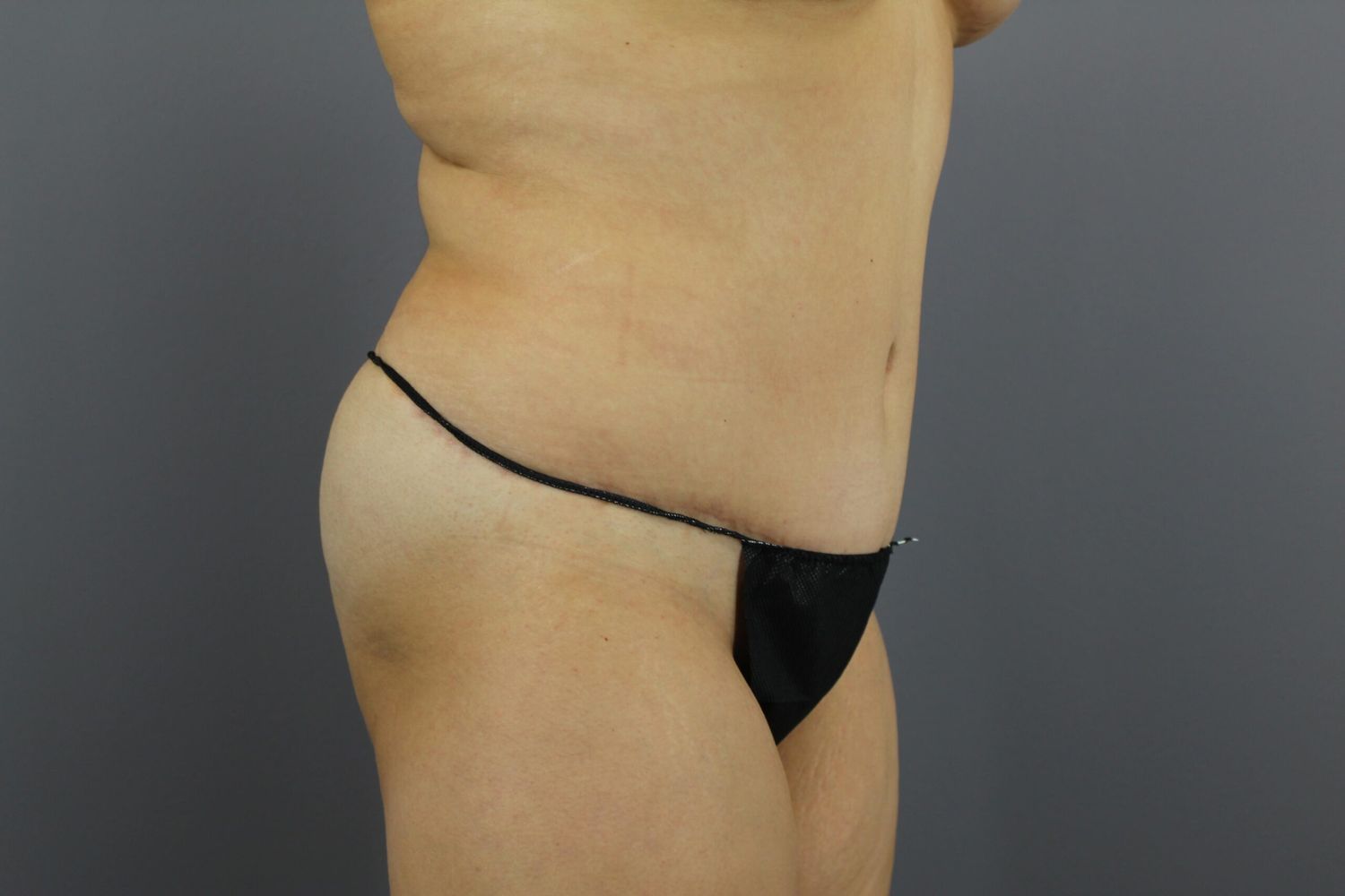 Tummy Tuck Before & After