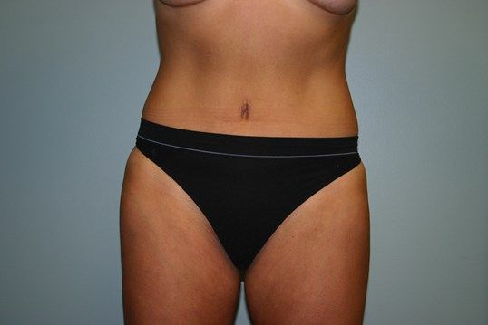 Tummy Tuck Before & After