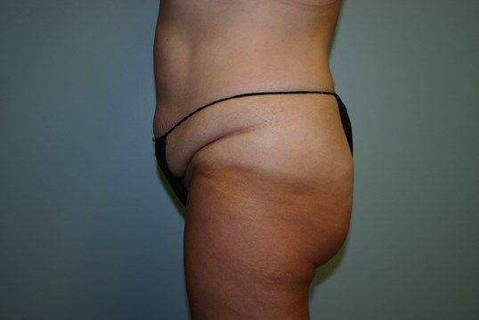 Tummy Tuck Before & After