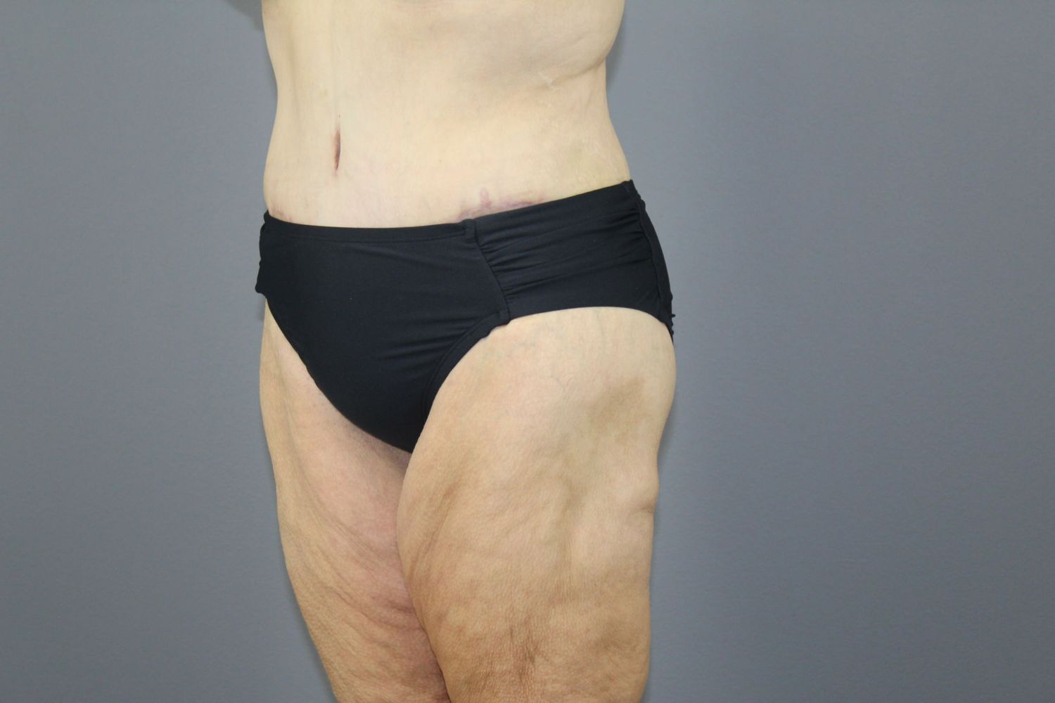 Tummy Tuck Before & After