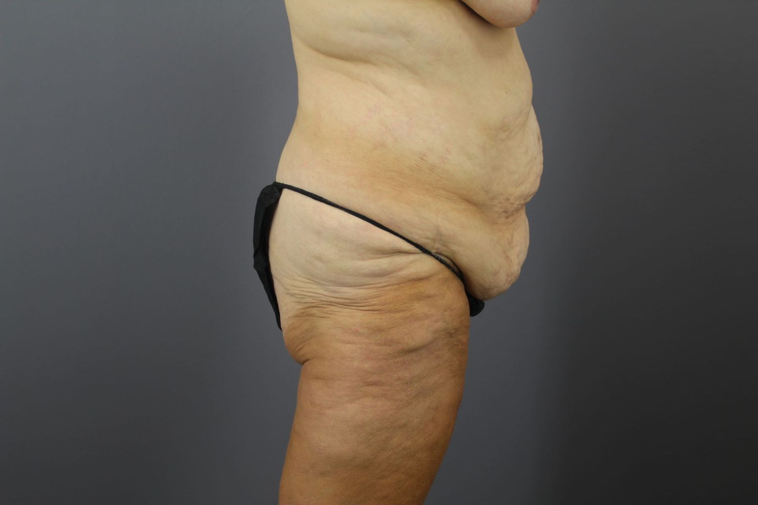 Tummy Tuck Before & After