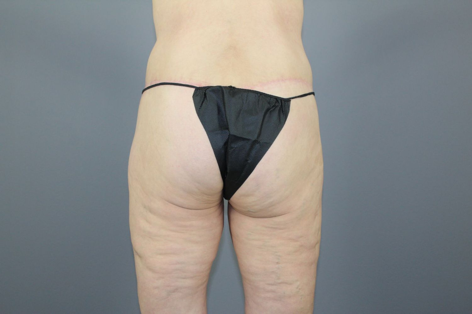 Tummy Tuck Before & After