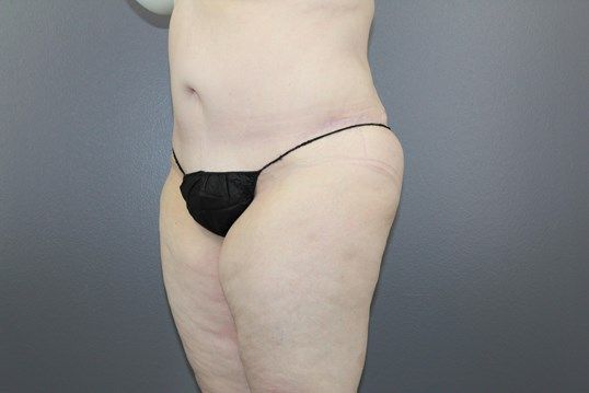 Tummy Tuck Before & After