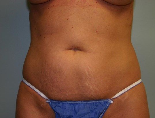 Tummy Tuck Before & After