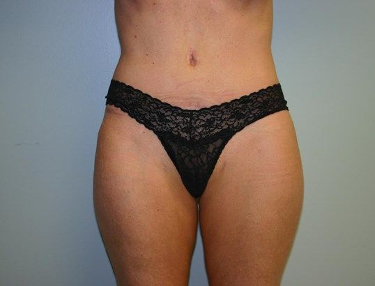 Tummy Tuck Before & After