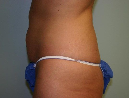 Tummy Tuck Before & After