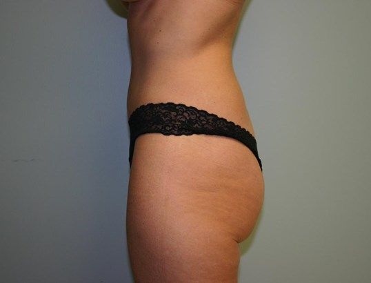 Tummy Tuck Before & After