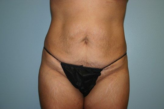 Tummy Tuck Before & After