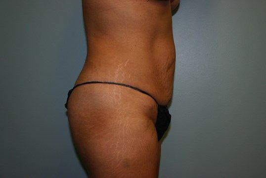 Tummy Tuck Before & After