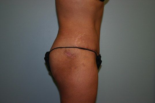 Tummy Tuck Before & After