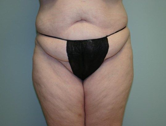 Tummy Tuck Before & After