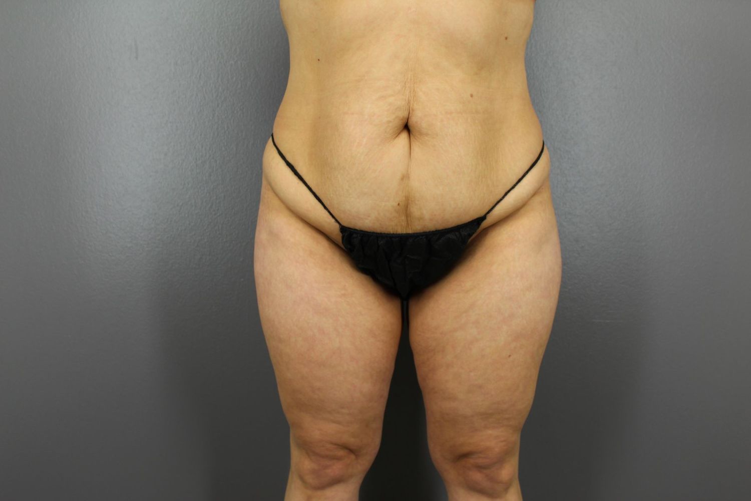 Tummy Tuck Before & After