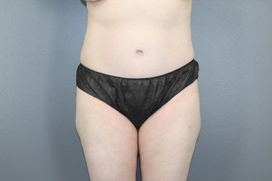 Tummy Tuck Before & After