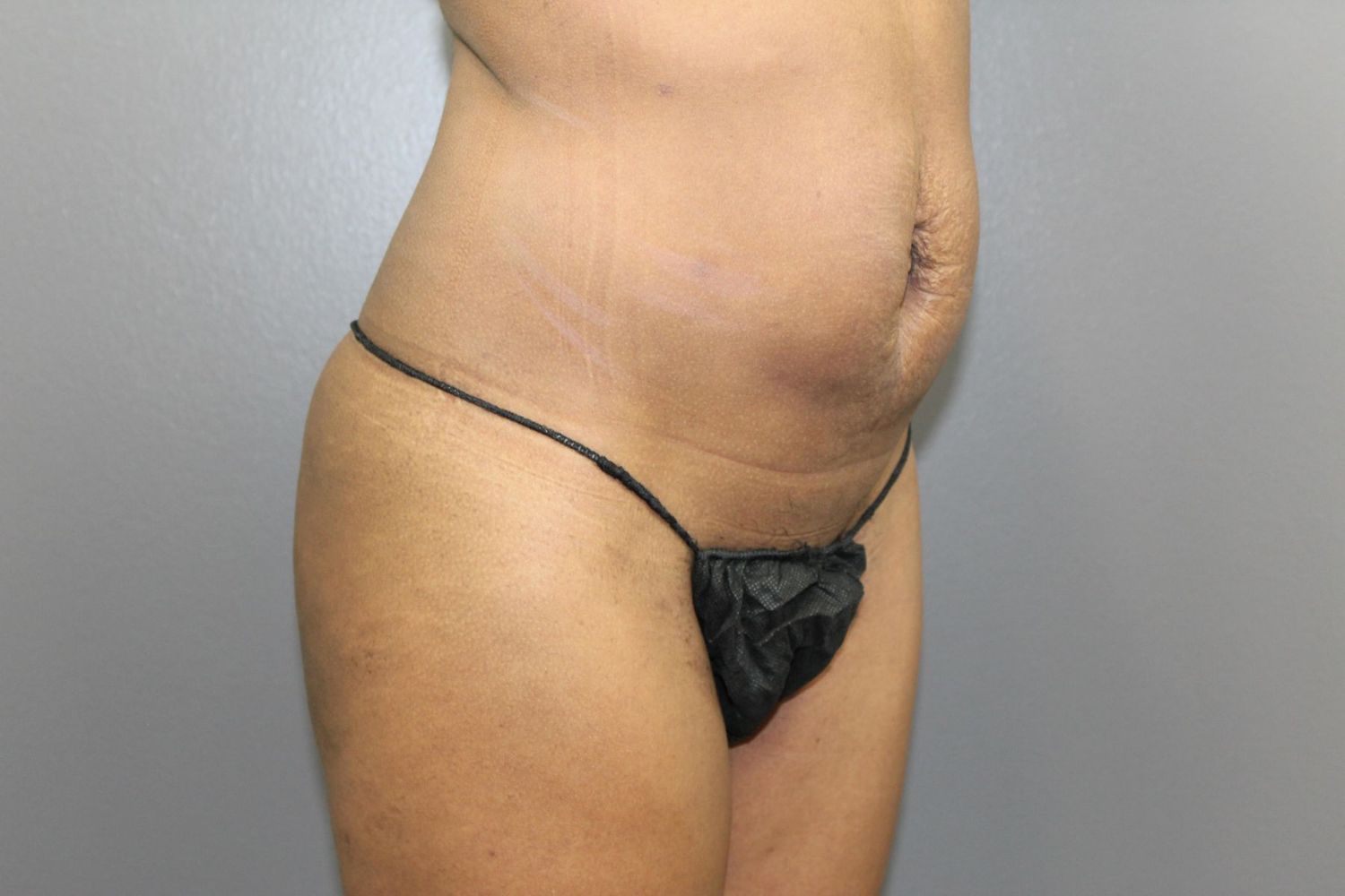 Tummy Tuck Before & After
